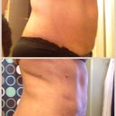 Before after right side