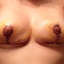 5 days post op--not the prettiest but a lot of healing ahead. I feel quite small but I know it takes some getting used to