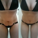 Before and Week 4, bent over forward... All I can say about this is: !!!!!!!!!!!!!!!!!!!!!!!! And seriously, that little bit off the inner thighs makes SUCH a huge difference, too! I really did get my dream procedure and dream results!