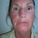 A few hours after my treatment...ready for a nap!