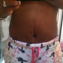 front view of my stomach 20 days post tt, my stretch marks are improving constantly. I have been using maderma, palmers scar/stretch mark oil and a scar treatment with silicone it everyday.