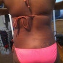 back view of liposuction areas