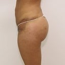 4 days after BBL with Dr. Perry