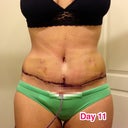 The weird lines u see on my tummy is from my binder, it kinda bunches up.