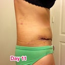 Day 11 side view