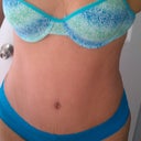 3 months post op
