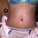 4 day post ops