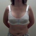 300cc R, 295cc L - postop day 1, still lot of swelling and the oh-so-flattering postop bra