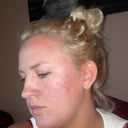 Next Day after.. Redness has gone down a lot ... Cant wait for 4 weeks And To Pump up the Treatment And See more Great Results :-)