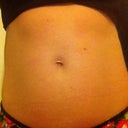 Before procedure front view - normally tightened muscles