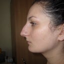 Before profile