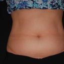 Lover abdomen and love handles 3months after