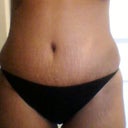 Bikini panties cover scar. Yeah