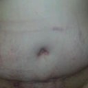 4 weeks post opp