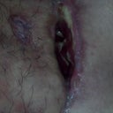 Its side ways. But this is my incision tat was opened to allow the fat necrosis to drain