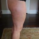 right lateral thigh, compare to the picture pre procedure - the dimples are practically GONE!