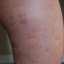 close up right lateral thigh