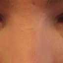 Dec15botheyes. Very bad swelling