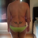 Back view of my back before surgery