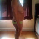 Right side view before surgery