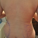 day 1 post op