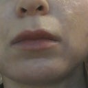 1 year and 10 days after ePrime: scars, brown spots, discoloration, sagging skin under the jowls and my face is still shifting on left side.
