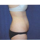Before SmartLipo