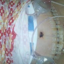 1 day post op. Ew, the belly button, for now, is yuck!
