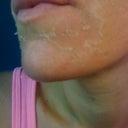 day 3 or 4 starting to peel