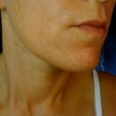 day 3 or 4 you can see contrast between old brown skin and new soft skin beneath.