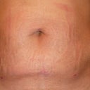 Look closely at the pic. See the string by my button? I thought the DR stitched it. I pulled it and fluid came out, so I left it alone until the next day at my follow up. It was a piece of fat, the Dr pulled it out!