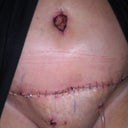 Bloody belly button 2/26/12