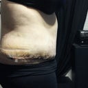 5 days post op