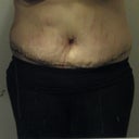 5 days post op