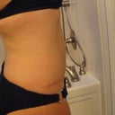 4 months PO side view