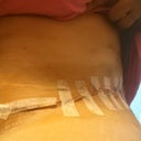 PO day 3 side view(begin to swell)