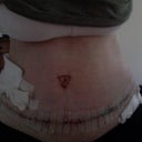 5 days after surgery