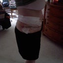5 days after surgery