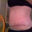 13 days after surgery, swelling down a little bit more