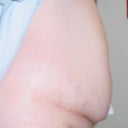 Before surgery picture