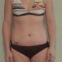 Before Surgery