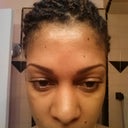 Day after injections.