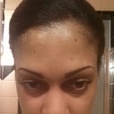 One month after injections. I love it! I look younger and my eyebrows are lifted!