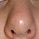 After first surgery- right side collapsed