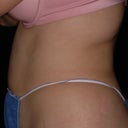 Side View before
