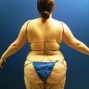 Preop Back