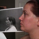 Day 23 Chin with Preop Chin photo