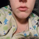 Before Procedure (.8cc. Juvederm XC to top lip only)
