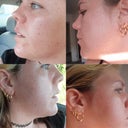 Before is before I got any treatments and After is today, after 5 treatments.