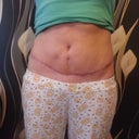 7 weeks po. this was taken the morning after 2 nights out drinking and dancing